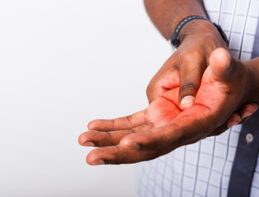 Surge in Hand, Foot and Mouth Disease Hits Bulawayo — Health Alert Issued Surge in Hand, Foot and Mouth Disease Hits Bulawayo — Health Alert Issued